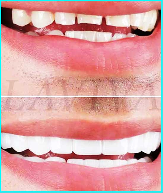 photos of veneers before and after