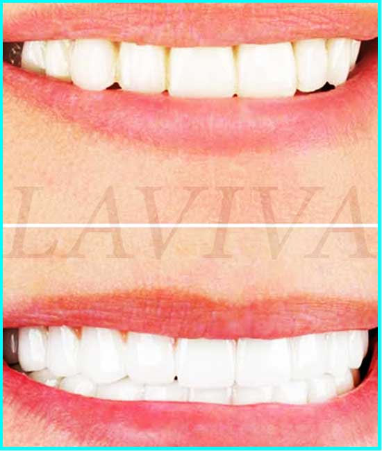 vor und nach der Zahnreinigung