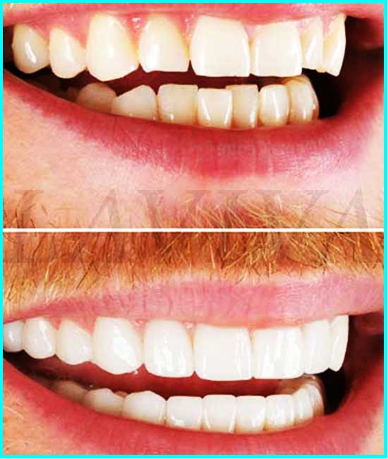dental veneer before after