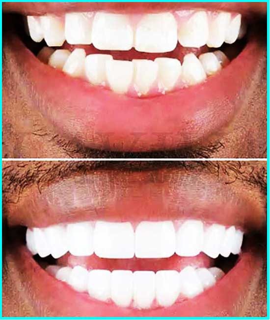 teeth whitening results before after
