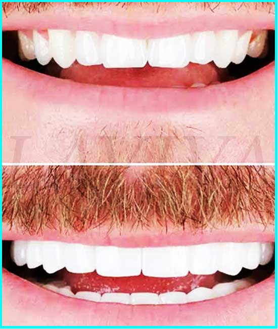 vor und nach der Zahnreinigung