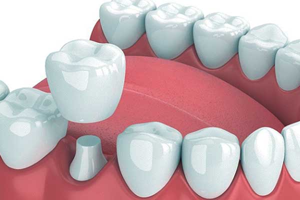 Dental Crowns in Turkey