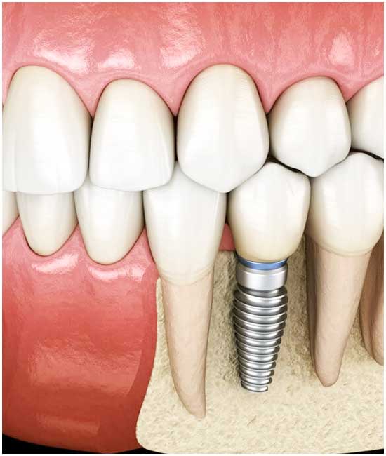 Implants dentaires en Turquie