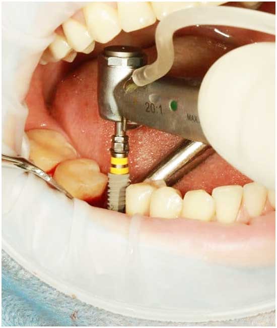 Dental Implants in Turkey: Types, Prices, Procedures and Patients Reviews