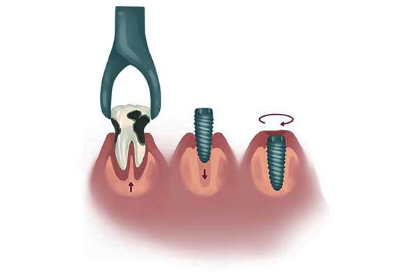 العلاج الفوري لزراعة الأسنان في تركيا