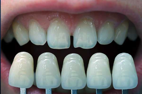 Dental Crowns in Turkey