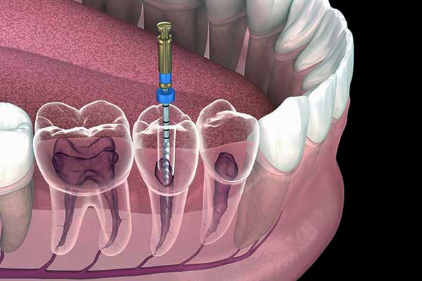 Root canal treatment in Turkey