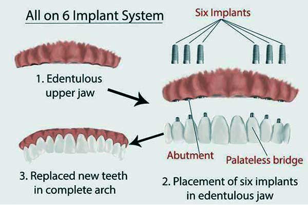 Estágios de implantação All-on-6