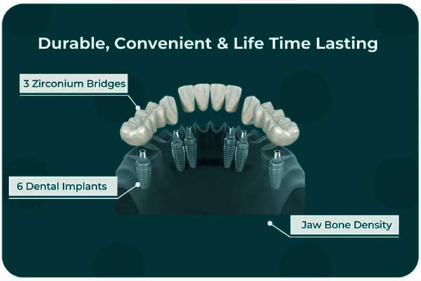 Das 3-auf-6-Zahnimplantatverfahren