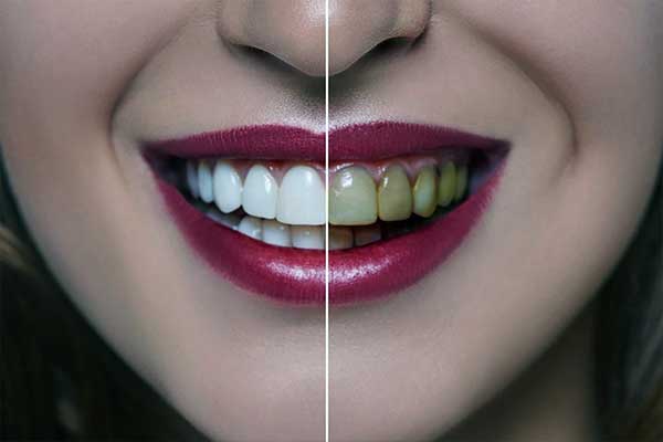 Blanchiment des dents en Turquie : prix des forfaits, avis et procédure