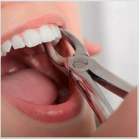 Tooth Extraction in Turkey