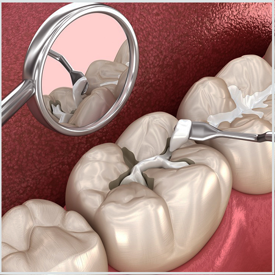 Otturazioni dentali in Turchia