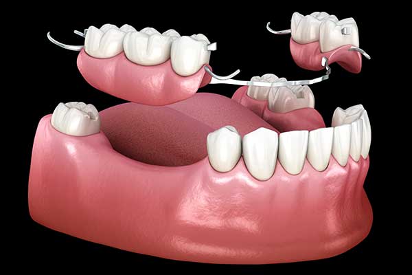 أنواع أطقم الأسنان التجميلية