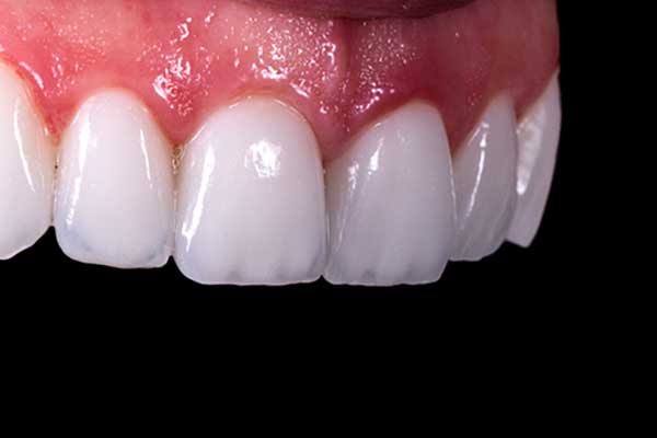 Dentales Komposit-Bonding
