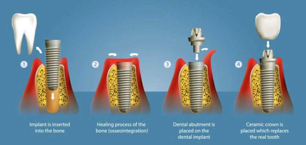 Número de visitas necessárias para procedimento de instalação de implantes dentários na Turquia
