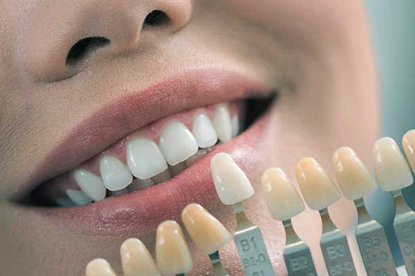 Transform Your Smile with Empress Veneers in Turkey