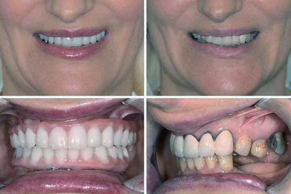 Duração do tratamento completo com implantes dentários na Turquia
