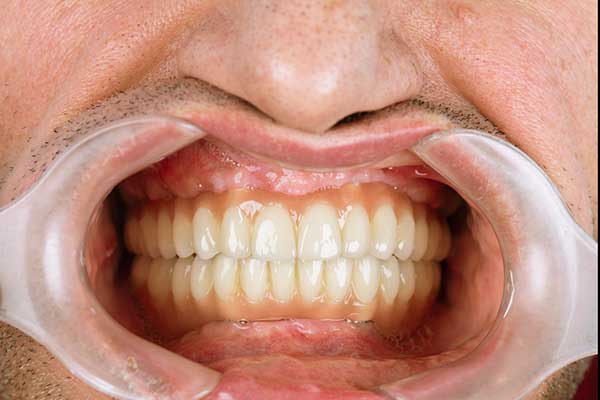 implantes dentários de boca cheia
