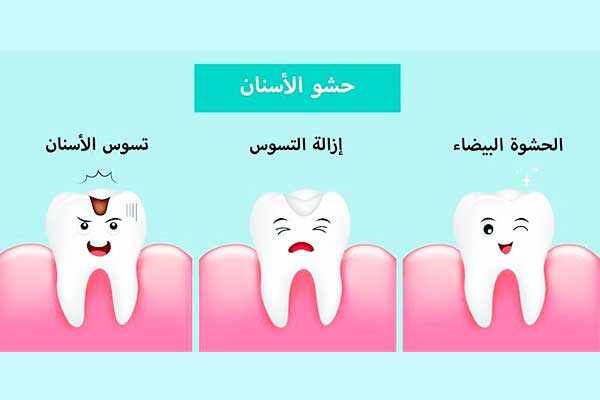 أنواع حشوات الأسنان: دليل شامل لاختيار الأفضل لابتسامة مشرقة