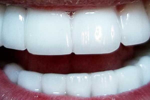 اسعار تلبيس الأسنان الزيركون في تركيا: دليلك الشامل