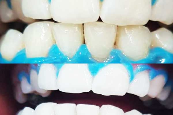 اسعار تنظيف الاسنان في تركيا