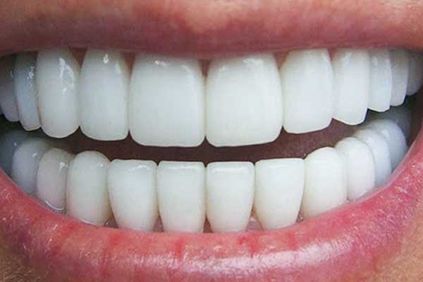 اسعار عدسات الاسنان في تركيا: دليلك الشامل للحصول على ابتسامة مثالية