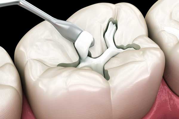 طريقة حشو الأسنان بالمنزل: دليل شامل للحفاظ على صحة الفم
