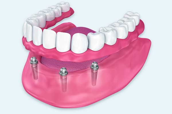 طقم أسنان ثابت: الحل الأمثل لابتسامة دائمة