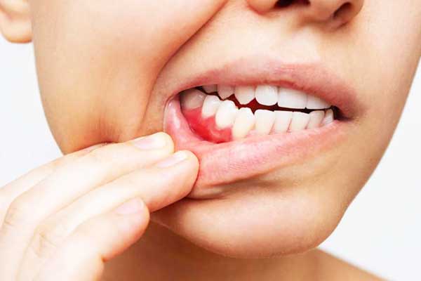 علاج التهاب اللثة بسبب طقم الأسنان